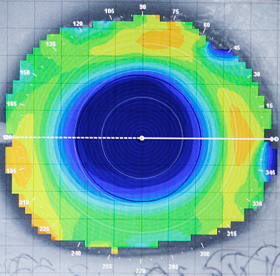 Corneal Topography